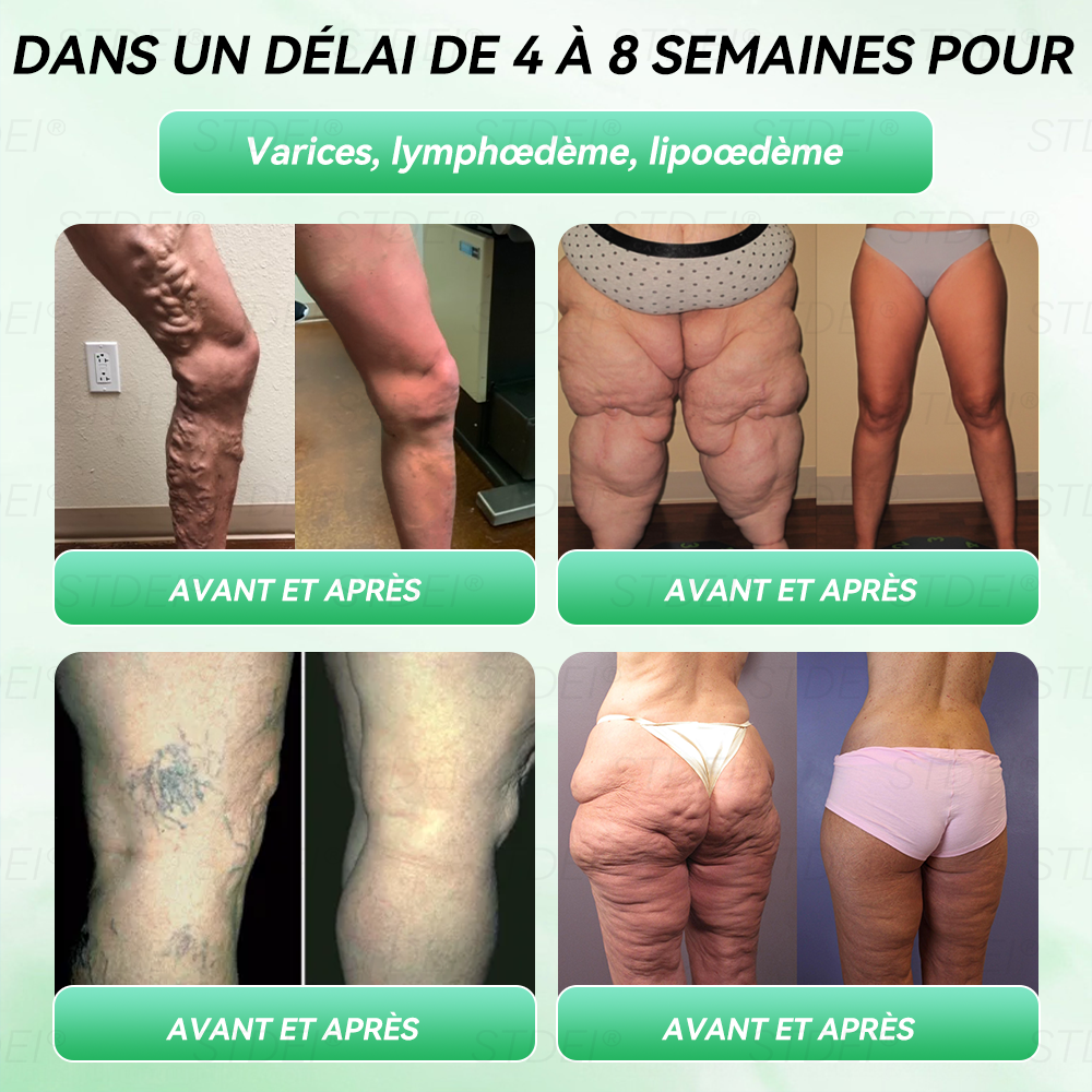 【Boutique officielle 】𝐒𝐓𝐃𝐄𝐈® 𝐆𝐋𝐏-𝟏 𝐌𝐢𝐧𝐜𝐞𝐮𝐫 𝐬𝐚𝐧𝐭é 𝐀𝐦𝐩𝐨𝐮𝐥𝐞 𝐒𝐨𝐥𝐮𝐭𝐢𝐨𝐧 𝐛𝐮𝐯𝐚𝐛𝐥𝐞 - 👨‍⚕️ Obésité, maladies cardiovasculaires, diabète, apnée du sommeil