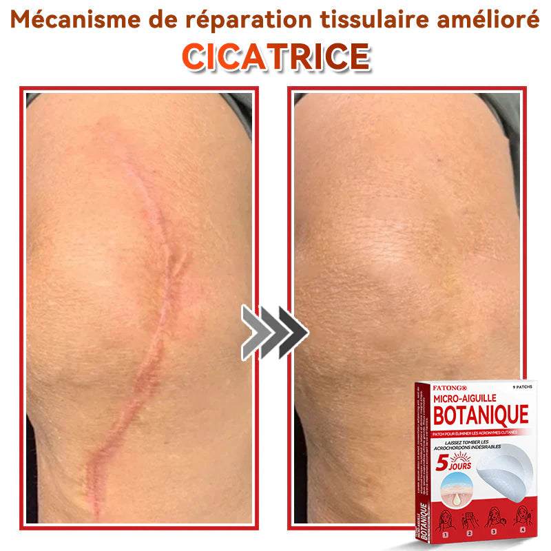 🌈𝐅𝐀𝐓𝐎𝐍𝐆®🍁💖𝐌𝐢𝐜𝐫𝐨-𝐀𝐢𝐠𝐮𝐢𝐥𝐥𝐞 𝐁𝐨𝐭𝐚𝐧𝐢𝐪𝐮𝐞 𝐏𝐚𝐭𝐜𝐡 𝐏𝐨𝐮𝐫 É𝐥𝐢𝐦𝐢𝐧𝐞𝐫 𝐋𝐞𝐬 𝐀𝐜𝐫𝐨𝐧𝐲𝐦𝐞𝐬 𝐂𝐮𝐭𝐚𝐧é𝐬 - 𝐔𝐧𝐞 𝐟𝐨𝐢𝐬 𝐩𝐚𝐫 𝐣𝐨𝐮𝐫, 𝐩𝐞𝐧𝐝𝐚𝐧𝐭 𝟔-𝟖 𝐡𝐞𝐮𝐫𝐞𝐬, é𝐥𝐢𝐦𝐢𝐧𝐞𝐳 𝐭𝐨𝐮𝐬 𝐥𝐞𝐬 𝐭𝐲𝐩𝐞𝐬 𝐝𝐞 𝐯𝐞𝐫𝐫𝐮𝐞𝐬 𝐜𝐮𝐭𝐚𝐧é𝐞𝐬 𝐞𝐧 𝐬𝐞𝐮𝐥𝐞𝐦𝐞𝐧𝐭 𝐒𝐲𝐧𝐭𝐚𝐱𝐞 𝐣𝐨𝐮𝐫𝐬