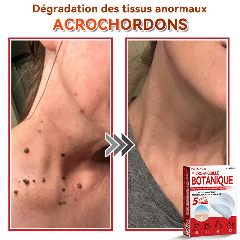 🌈𝐅𝐀𝐓𝐎𝐍𝐆®🍁💖𝐌𝐢𝐜𝐫𝐨-𝐀𝐢𝐠𝐮𝐢𝐥𝐥𝐞 𝐁𝐨𝐭𝐚𝐧𝐢𝐪𝐮𝐞 𝐏𝐚𝐭𝐜𝐡 𝐏𝐨𝐮𝐫 É𝐥𝐢𝐦𝐢𝐧𝐞𝐫 𝐋𝐞𝐬 𝐀𝐜𝐫𝐨𝐧𝐲𝐦𝐞𝐬 𝐂𝐮𝐭𝐚𝐧é𝐬 - 𝐔𝐧𝐞 𝐟𝐨𝐢𝐬 𝐩𝐚𝐫 𝐣𝐨𝐮𝐫, 𝐩𝐞𝐧𝐝𝐚𝐧𝐭 𝟔-𝟖 𝐡𝐞𝐮𝐫𝐞𝐬, é𝐥𝐢𝐦𝐢𝐧𝐞𝐳 𝐭𝐨𝐮𝐬 𝐥𝐞𝐬 𝐭𝐲𝐩𝐞𝐬 𝐝𝐞 𝐯𝐞𝐫𝐫𝐮𝐞𝐬 𝐜𝐮𝐭𝐚𝐧é𝐞𝐬 𝐞𝐧 𝐬𝐞𝐮𝐥𝐞𝐦𝐞𝐧𝐭 𝐒𝐲𝐧𝐭𝐚𝐱𝐞 𝐣𝐨𝐮𝐫𝐬