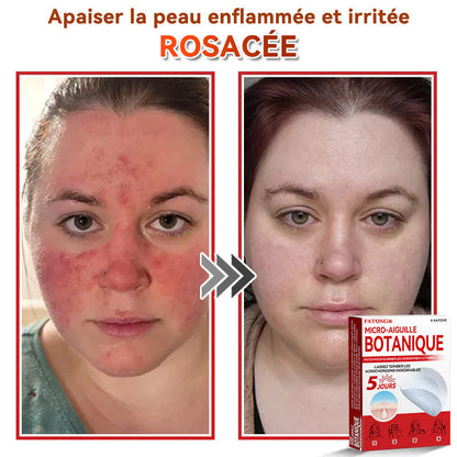 🌈𝐅𝐀𝐓𝐎𝐍𝐆®🍁💖𝐌𝐢𝐜𝐫𝐨-𝐀𝐢𝐠𝐮𝐢𝐥𝐥𝐞 𝐁𝐨𝐭𝐚𝐧𝐢𝐪𝐮𝐞 𝐏𝐚𝐭𝐜𝐡 𝐏𝐨𝐮𝐫 É𝐥𝐢𝐦𝐢𝐧𝐞𝐫 𝐋𝐞𝐬 𝐀𝐜𝐫𝐨𝐧𝐲𝐦𝐞𝐬 𝐂𝐮𝐭𝐚𝐧é𝐬 - 𝐔𝐧𝐞 𝐟𝐨𝐢𝐬 𝐩𝐚𝐫 𝐣𝐨𝐮𝐫, 𝐩𝐞𝐧𝐝𝐚𝐧𝐭 𝟔-𝟖 𝐡𝐞𝐮𝐫𝐞𝐬, é𝐥𝐢𝐦𝐢𝐧𝐞𝐳 𝐭𝐨𝐮𝐬 𝐥𝐞𝐬 𝐭𝐲𝐩𝐞𝐬 𝐝𝐞 𝐯𝐞𝐫𝐫𝐮𝐞𝐬 𝐜𝐮𝐭𝐚𝐧é𝐞𝐬 𝐞𝐧 𝐬𝐞𝐮𝐥𝐞𝐦𝐞𝐧𝐭 𝐒𝐲𝐧𝐭𝐚𝐱𝐞 𝐣𝐨𝐮𝐫𝐬